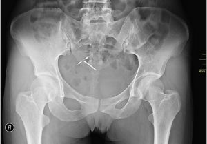 IUD - Coil