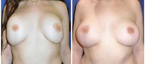 Αφαίρεση ενθεμάτων σιλικόνης στήθους #2